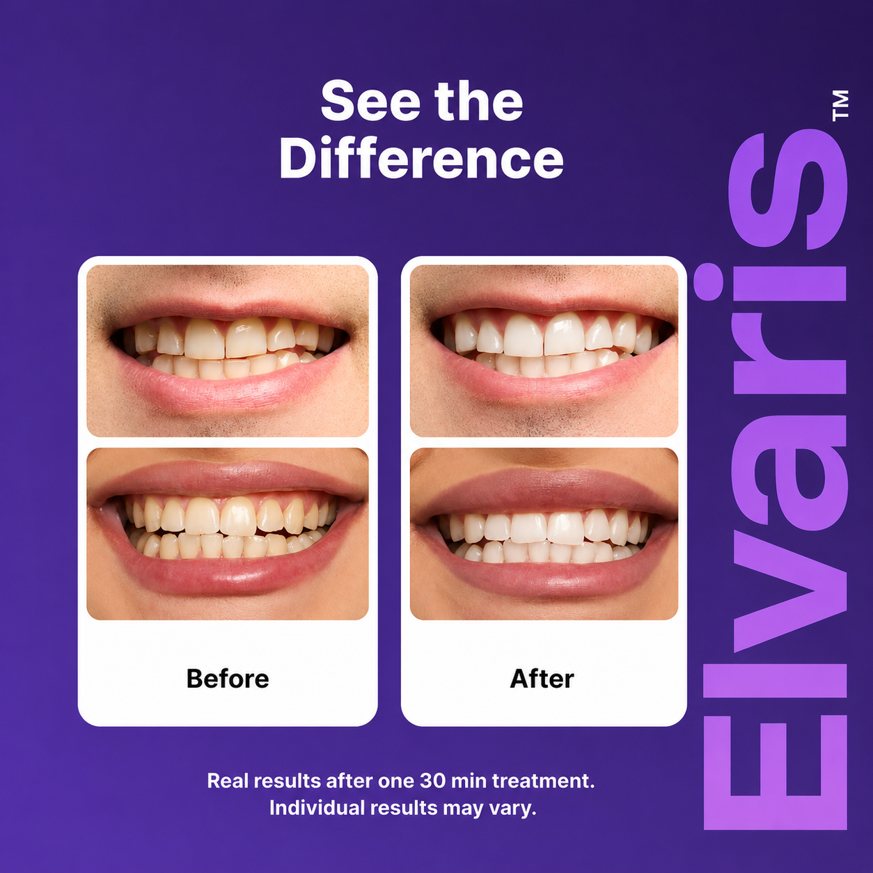 Elvaris™ Purple Whitening Strips